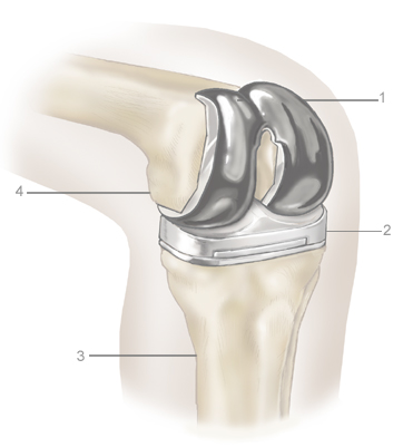 2.-Knee-replacementA