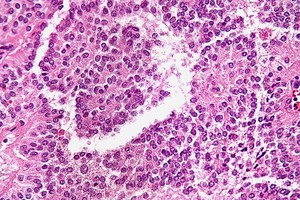 Stained Solid Tumor