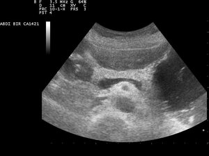 Ultrasound_image_of_pancreas_110328111508_1115360 FREE LIC NIH Ultrasound_image_of_pancreas_110328111508_1115360 FREE LIC NIH