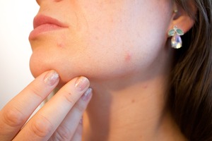 Skin Treatment acne-1606765_1920 by KMichaela PixaBay FREE LIC CC0
