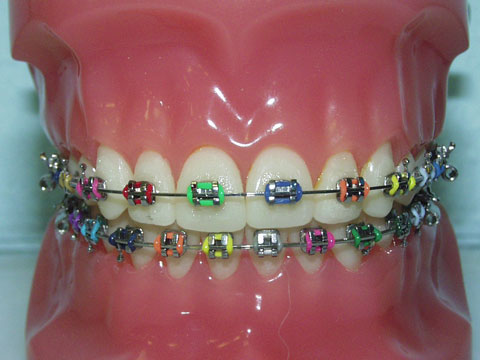 Cute Braces Colors